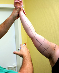 Liposuktion - Anzeichnen am Arm