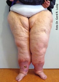 Lipödem plus Lymphödem mit Erysipel (Wundrose)